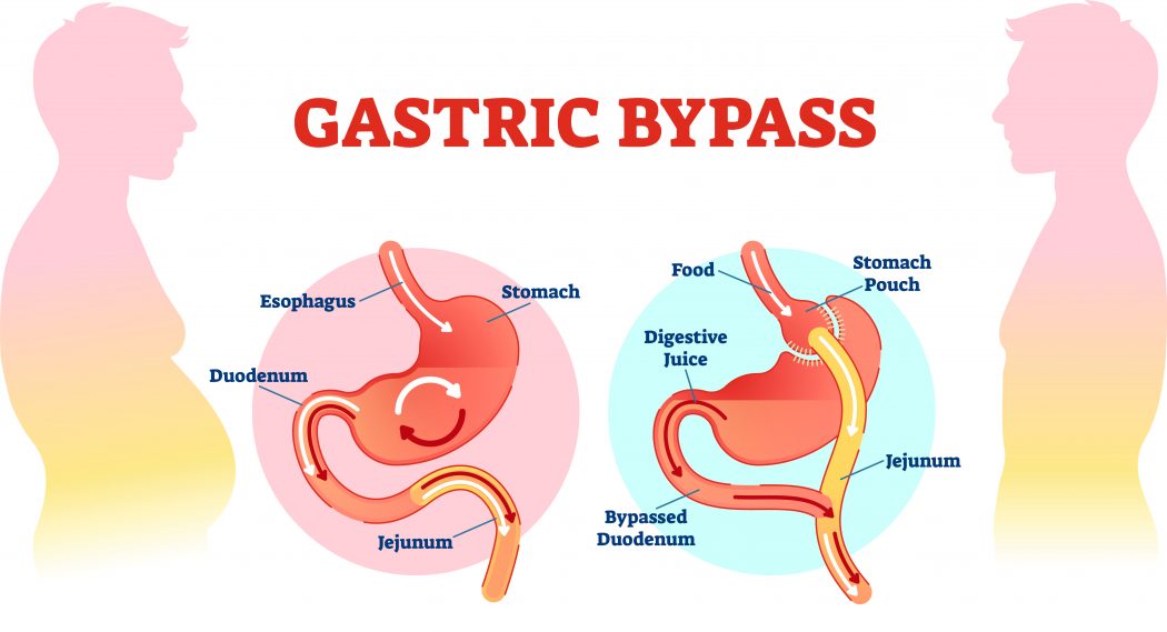 How to Restart Weight Loss After Gastric Bypass